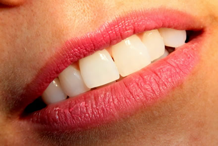 Dental teeth whitening and veneers Costa del Sol, Swedish dentists, fuengirola, mijas costa, riviera del sol