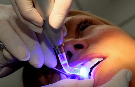 fuengirola Teeth whitening Costa del Sol, Clinica Idea,