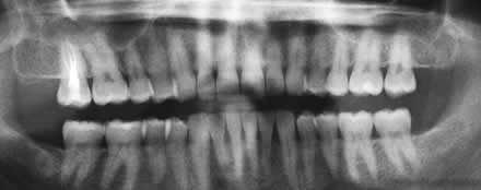 Dental xray Costa del Sol, Clinica Dental Idea